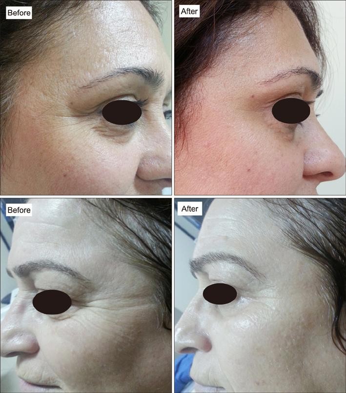 PRP Facial Before and After One Treatment: Evidence-Based Review