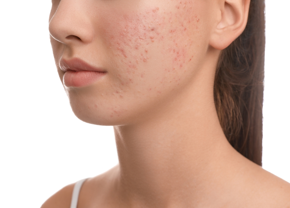 How to Improve Skin Texture with PRP