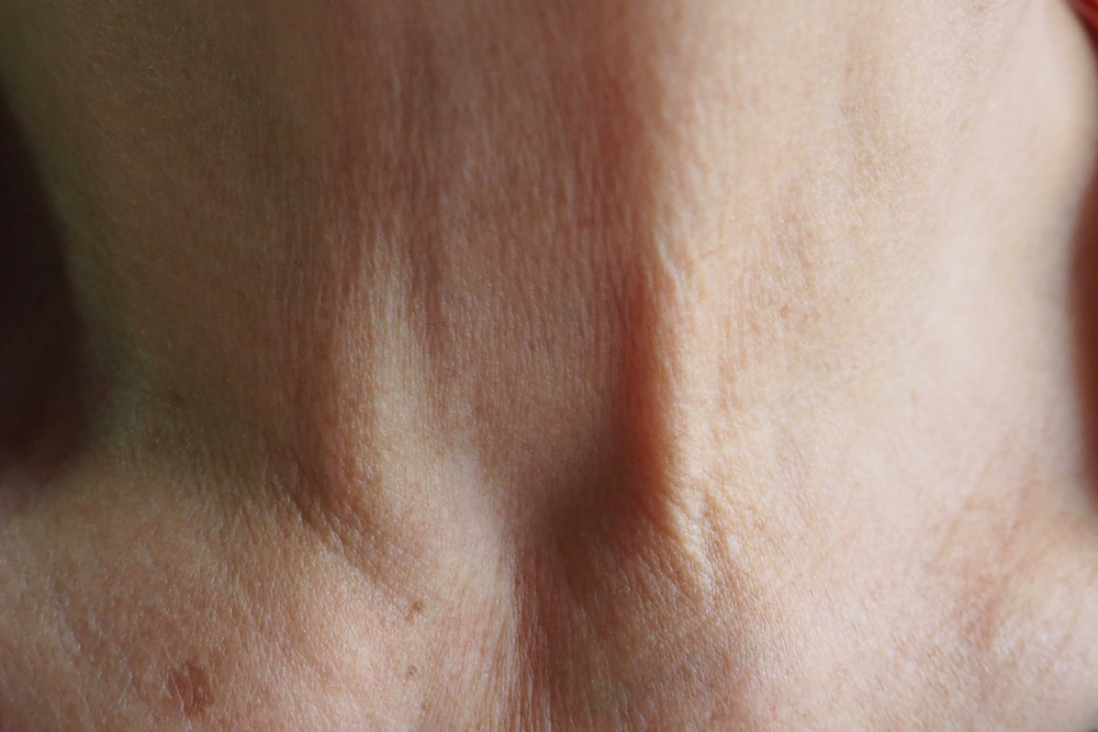 How to Tighten Neck Skin With PRP Injections: An Analysis of Effectiveness