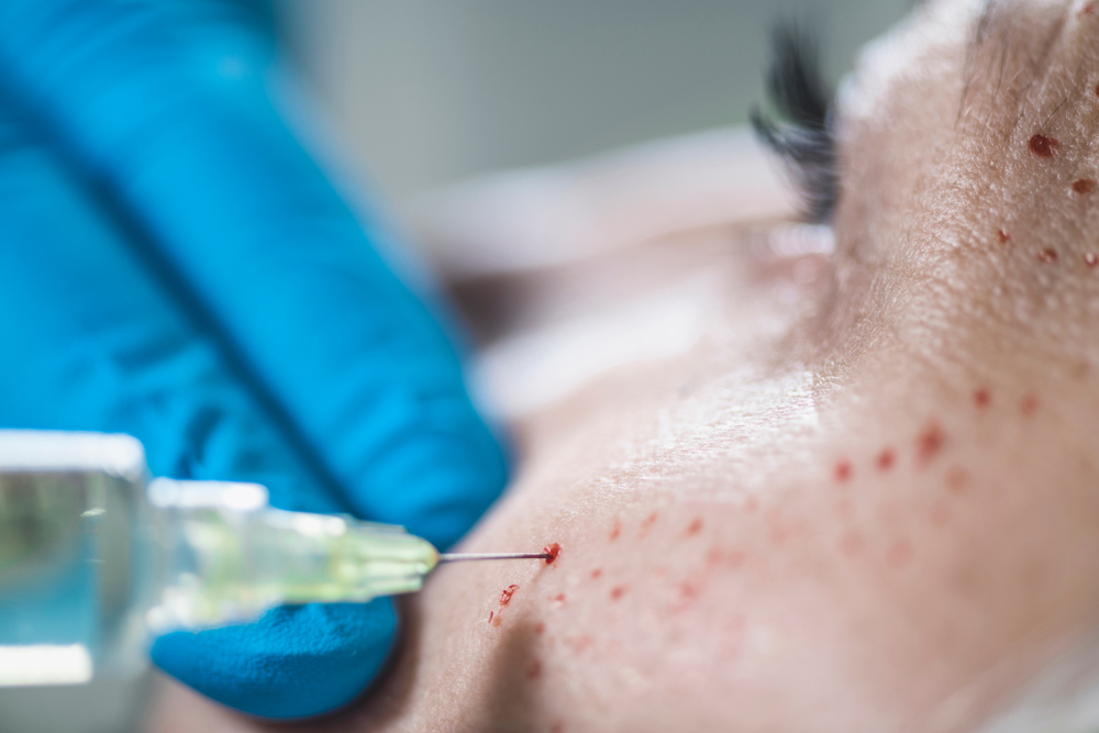What Is a Vampire Facial, and Who Can Benefit From It?