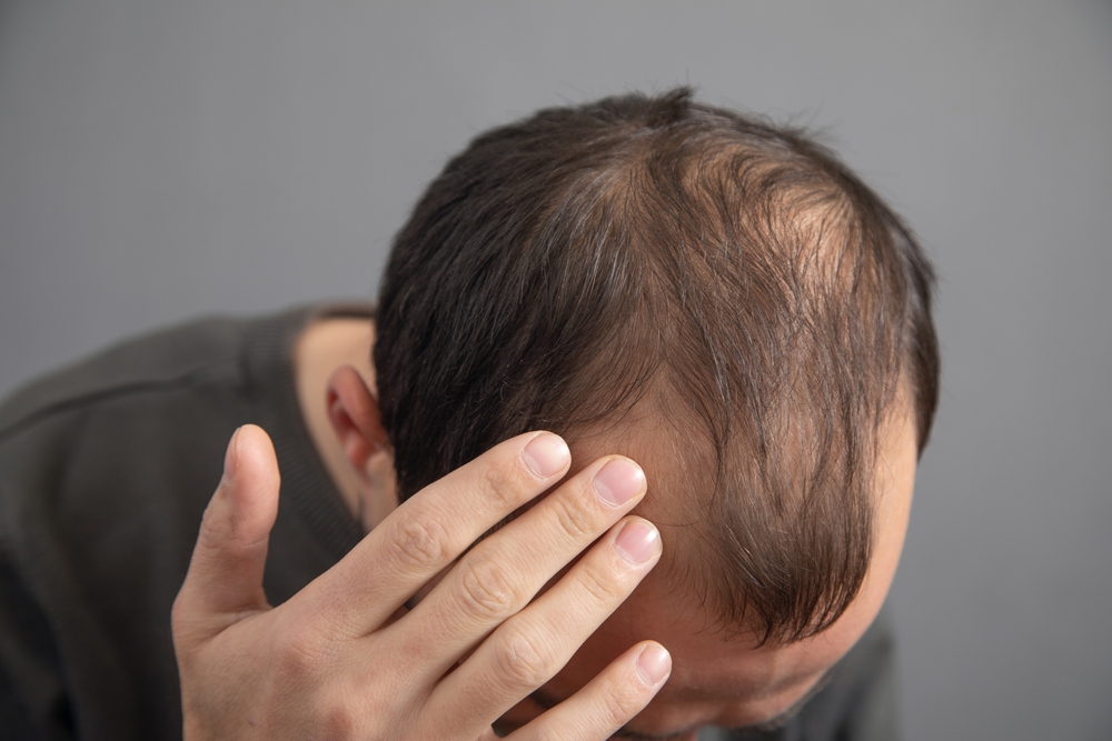 Understanding the PRP Hair Treatment Success Rate