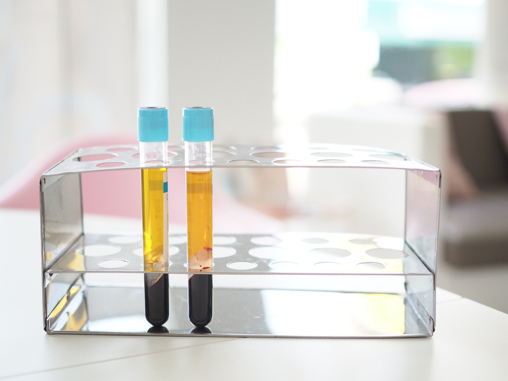 PRF Treatment: The Ultimate Guide