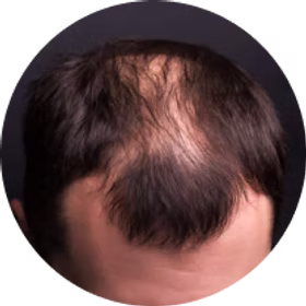 Hair Restoration